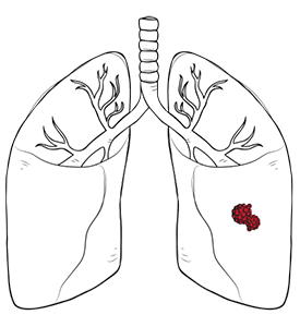 benign lung tumours