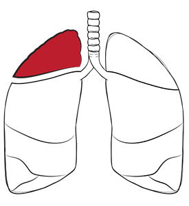 lung volume reduction surgery