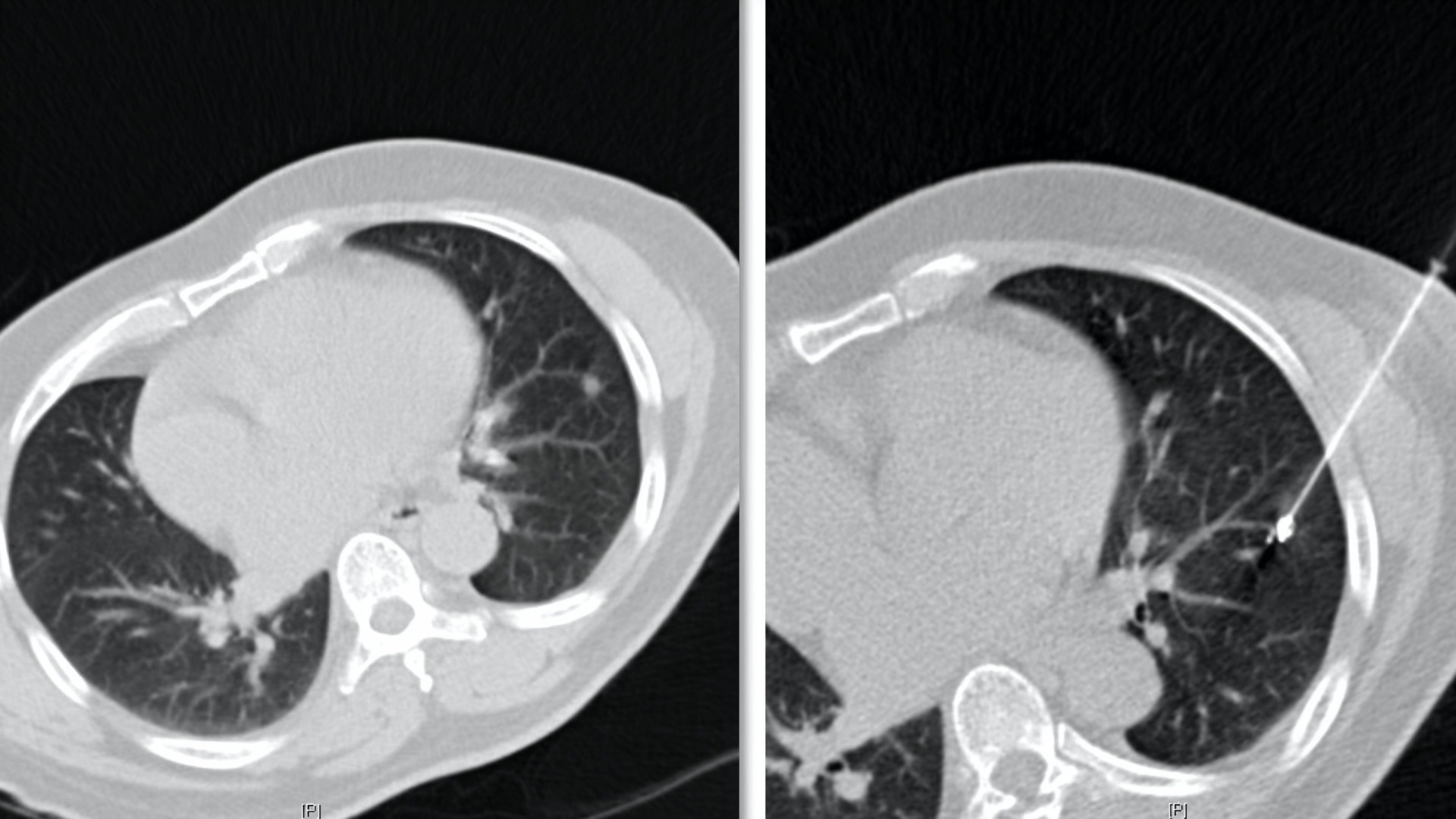 CT-guided lung biopsy microcoil