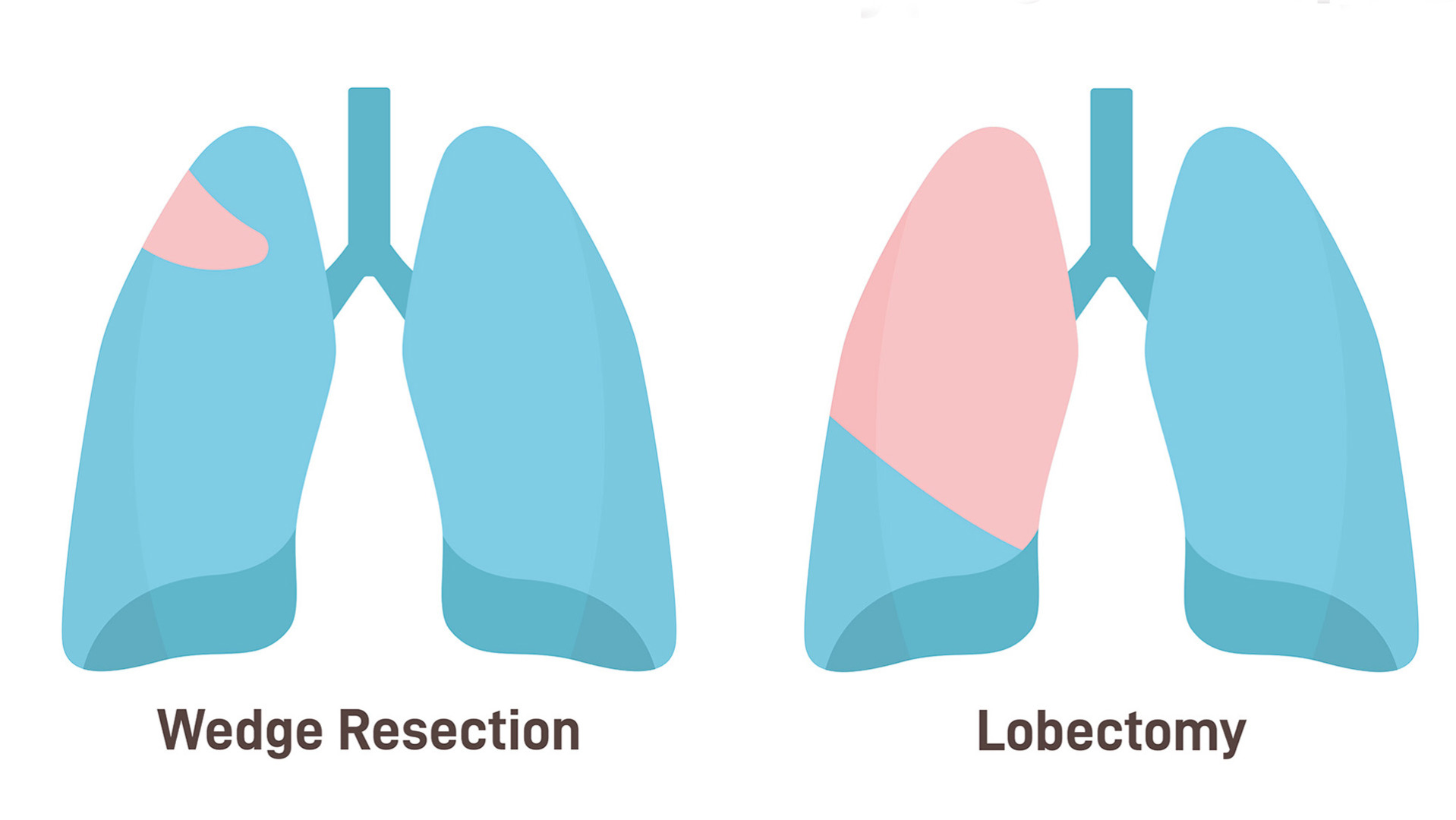 Lung Wedge Resection vs Lobectomy