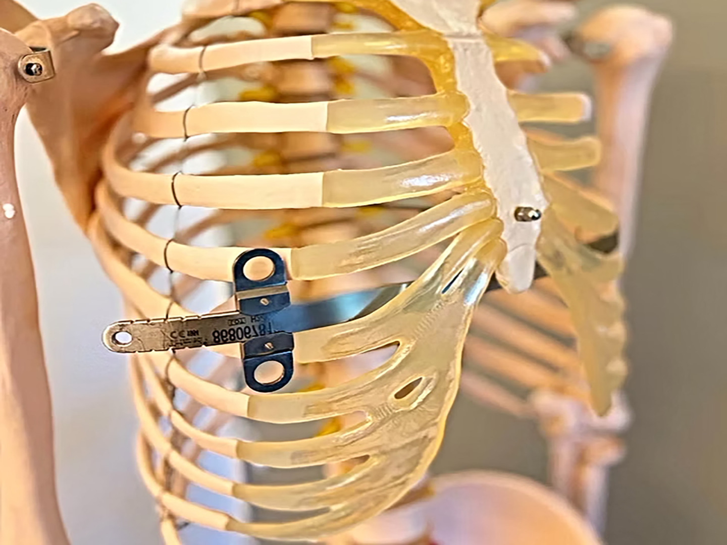 Nuss Procedure for Pectus Excavatum Treatment