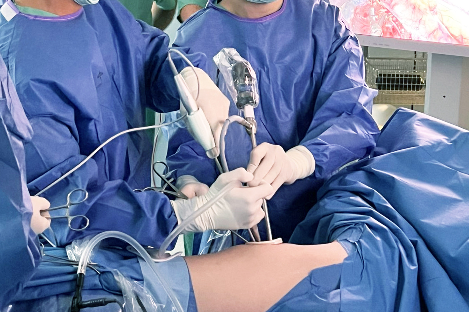 Singapore U-VATS for empyema thoracis