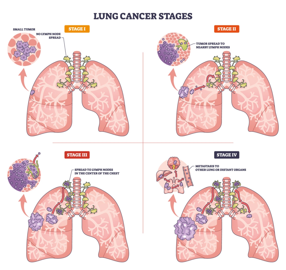 Stage 2 lung cancer