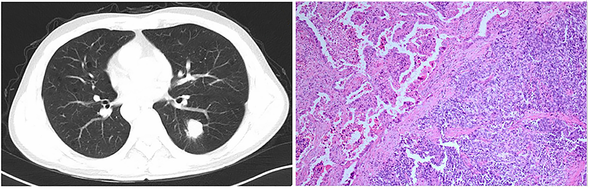 Stage 4 lung cancer Singapore