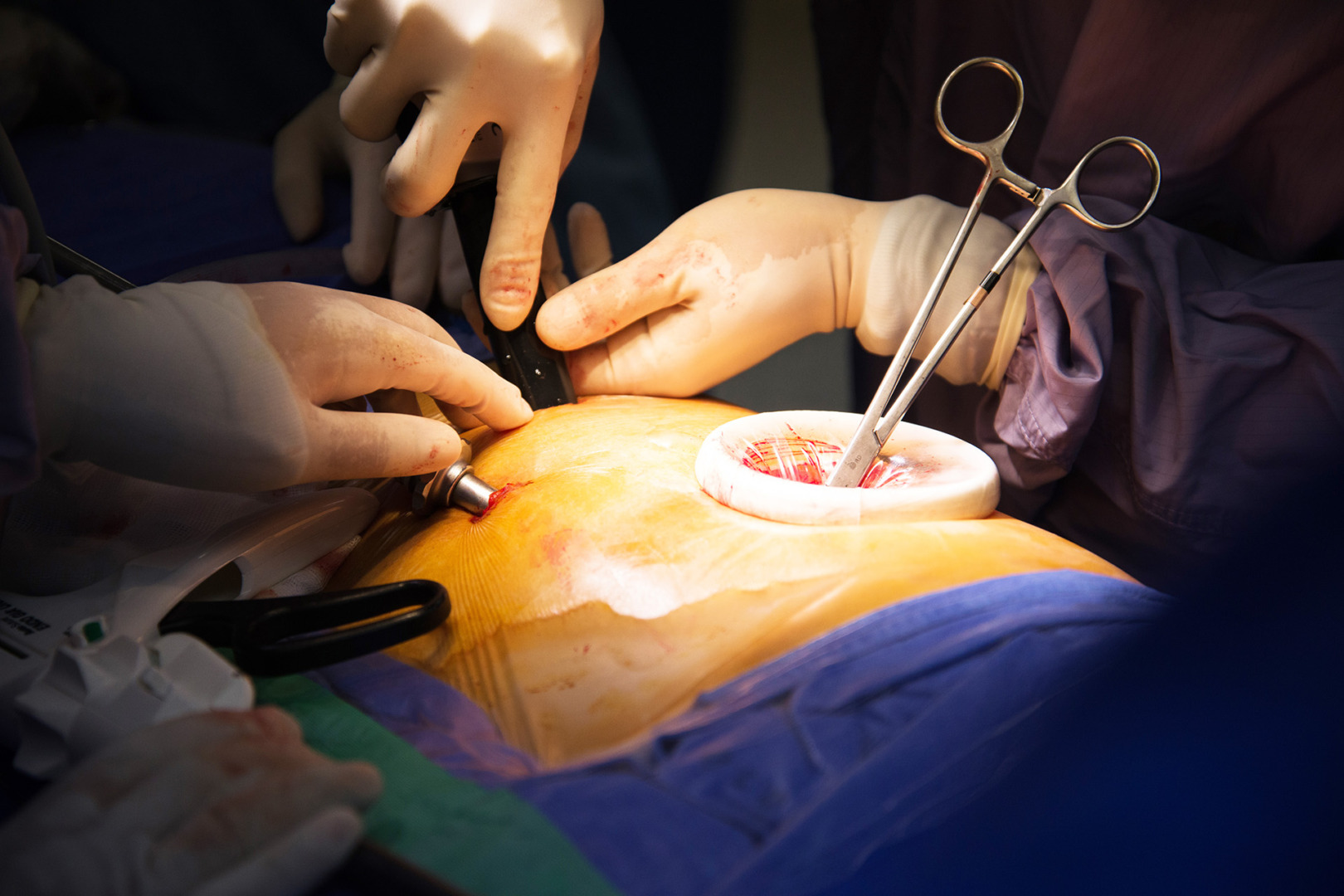 U-VATS for empyema thoracis