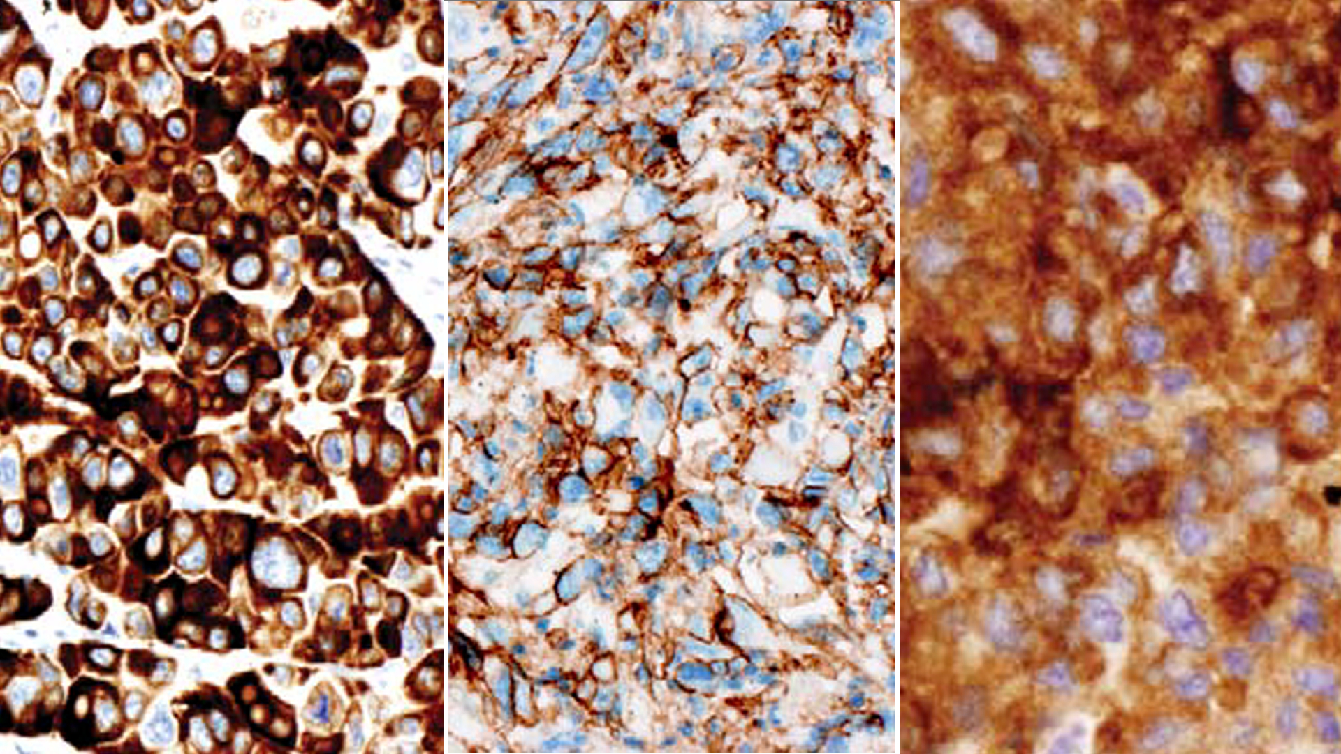 adenocarcinoma vs large cell carcinoma vs small cell carcinoma