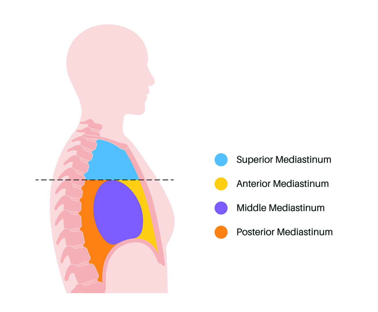 anterior mediastinal mass diagram