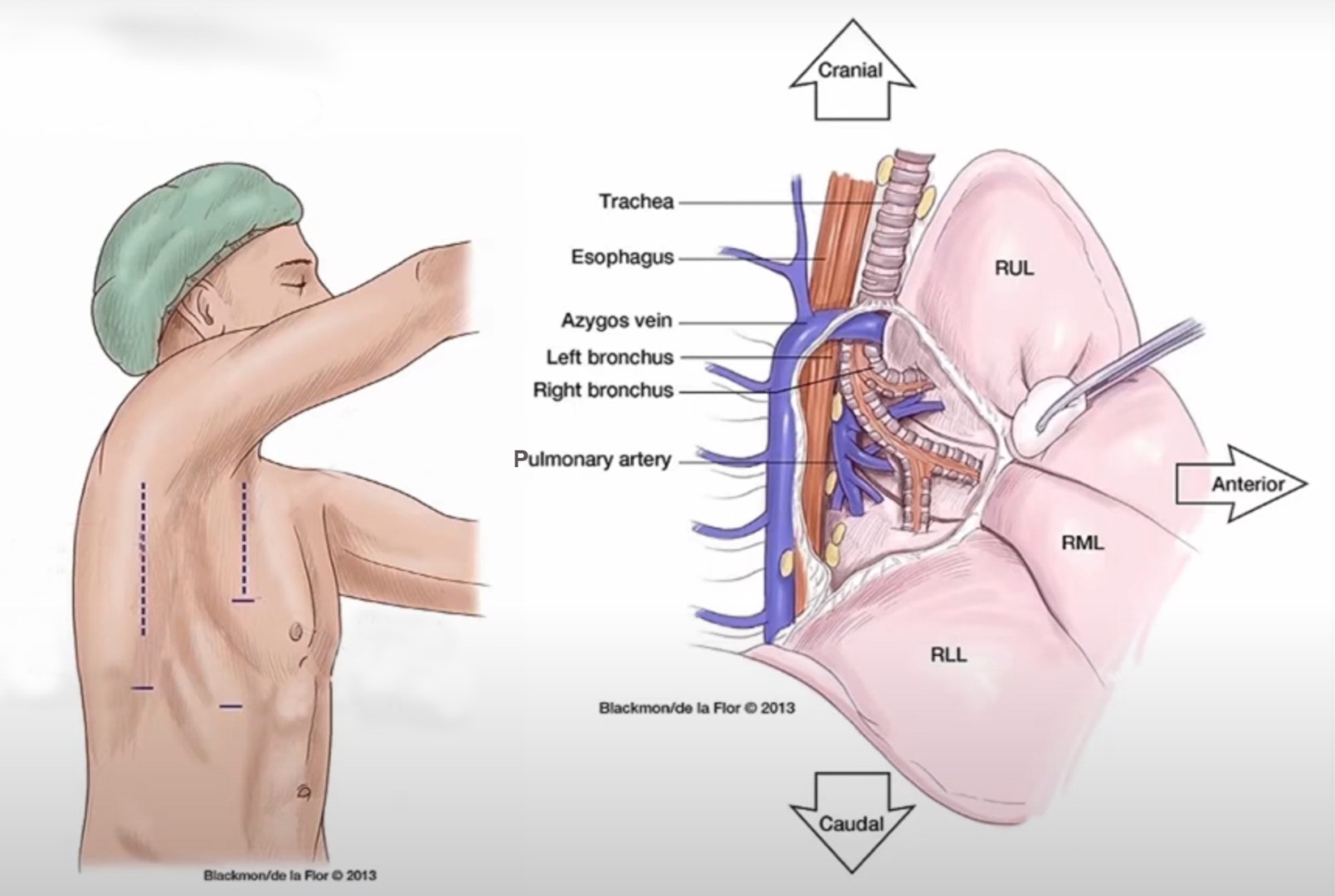 bronchogenic carcinoma treatment