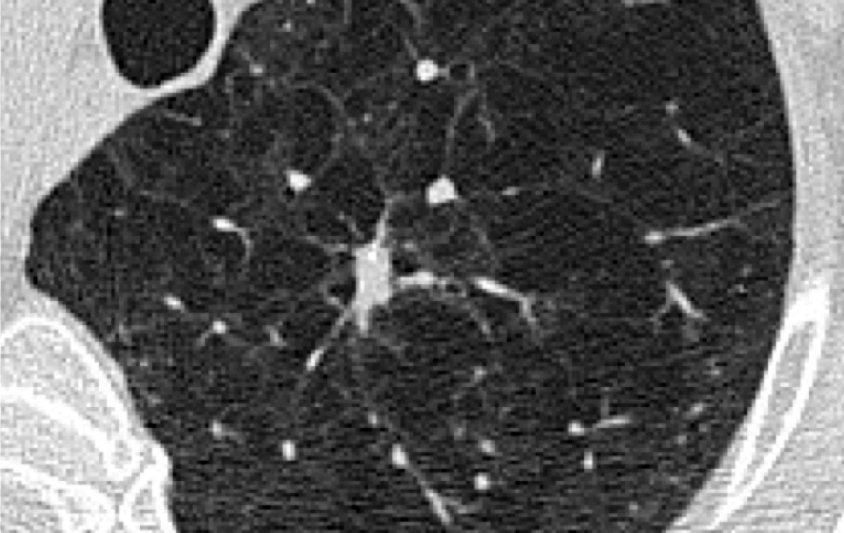calcified lung nodule X-ray