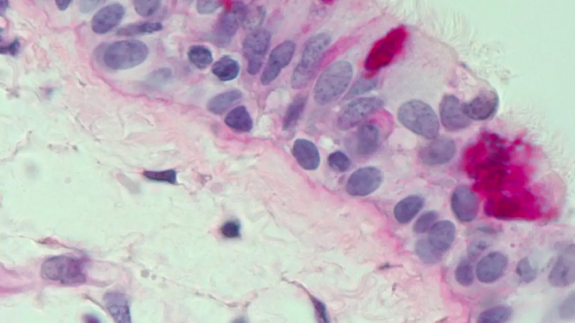 carcinoid tumour lung epithelial cells
