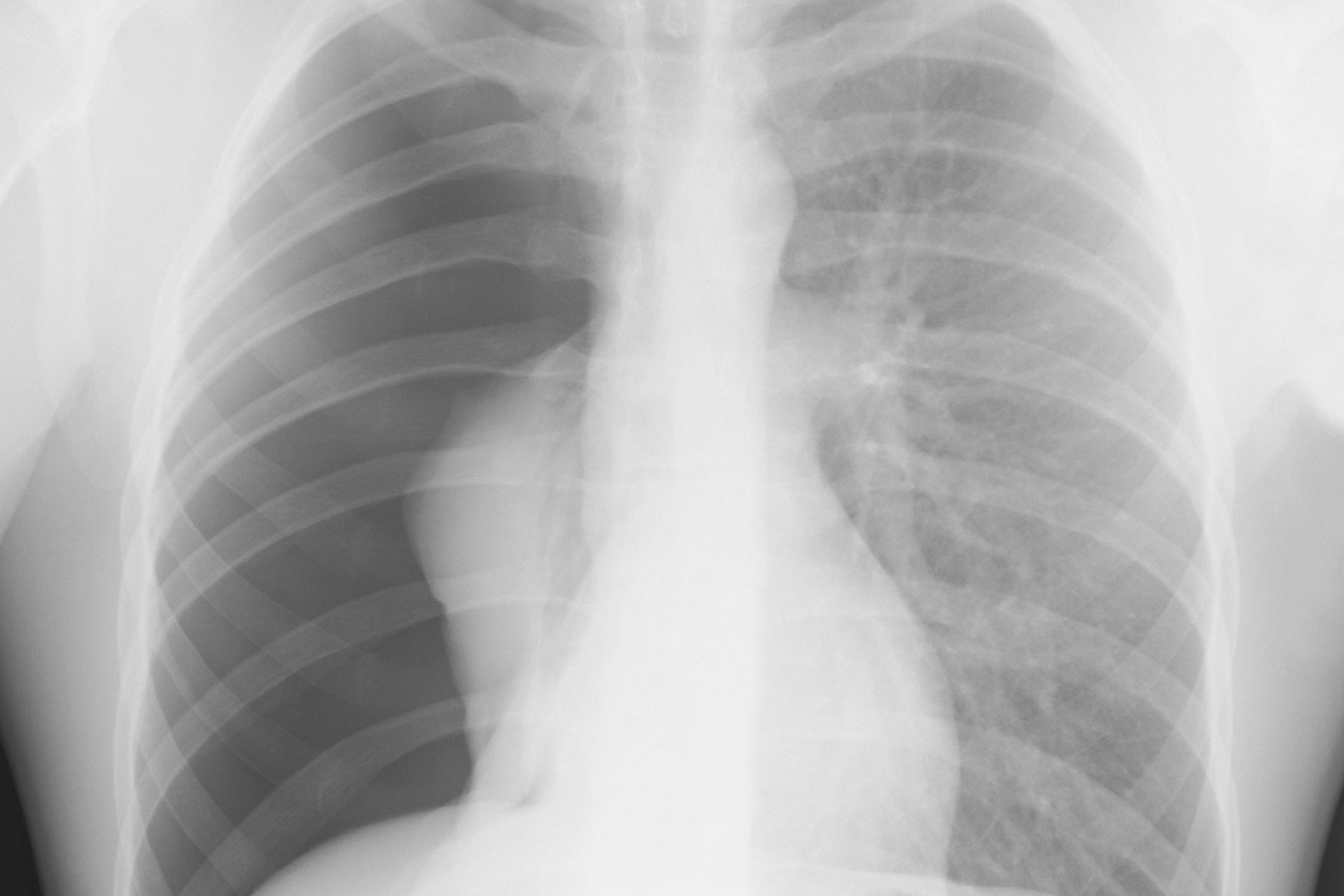 causes of closed pneumothorax