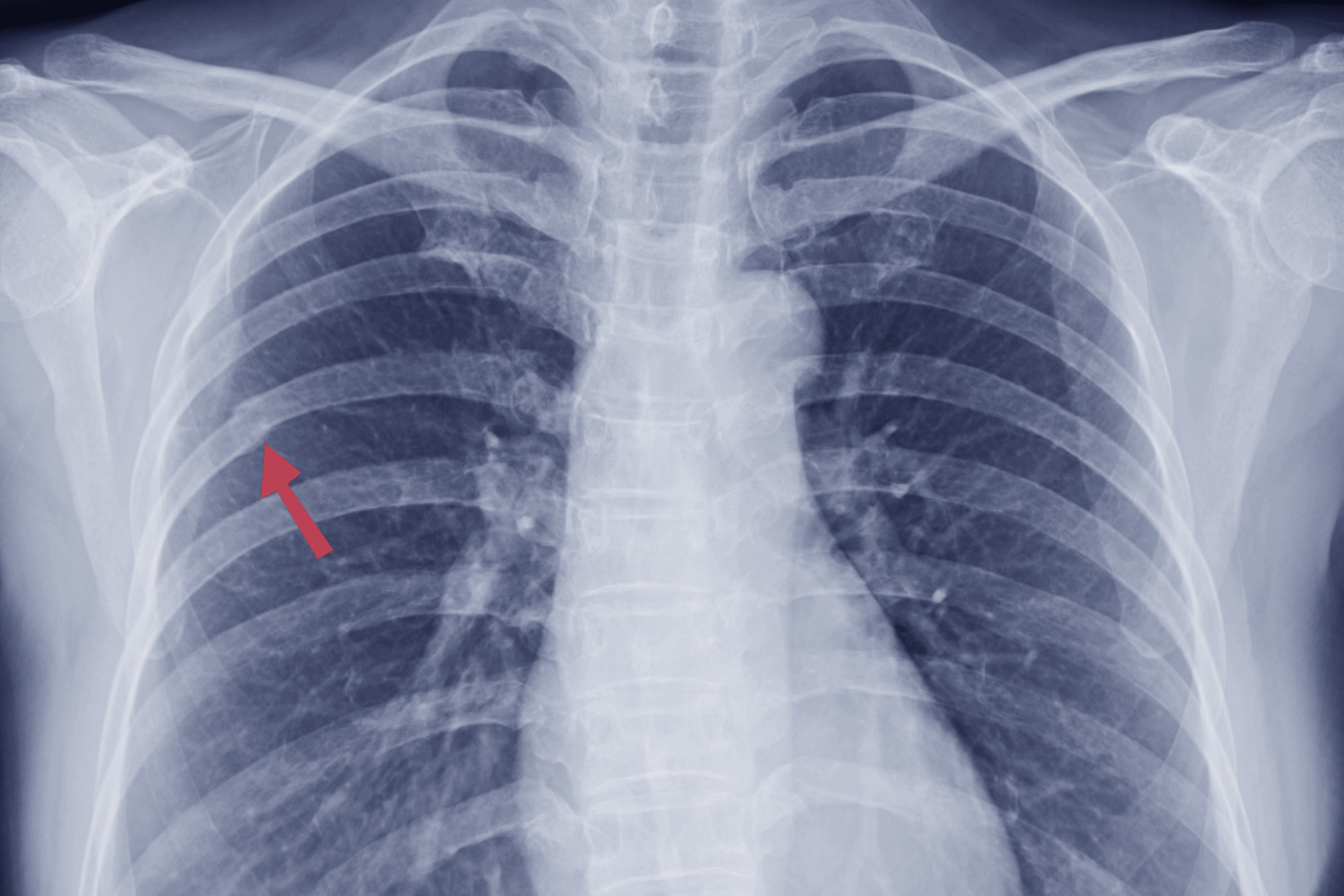 chronic rib fracture treatment in Singapore