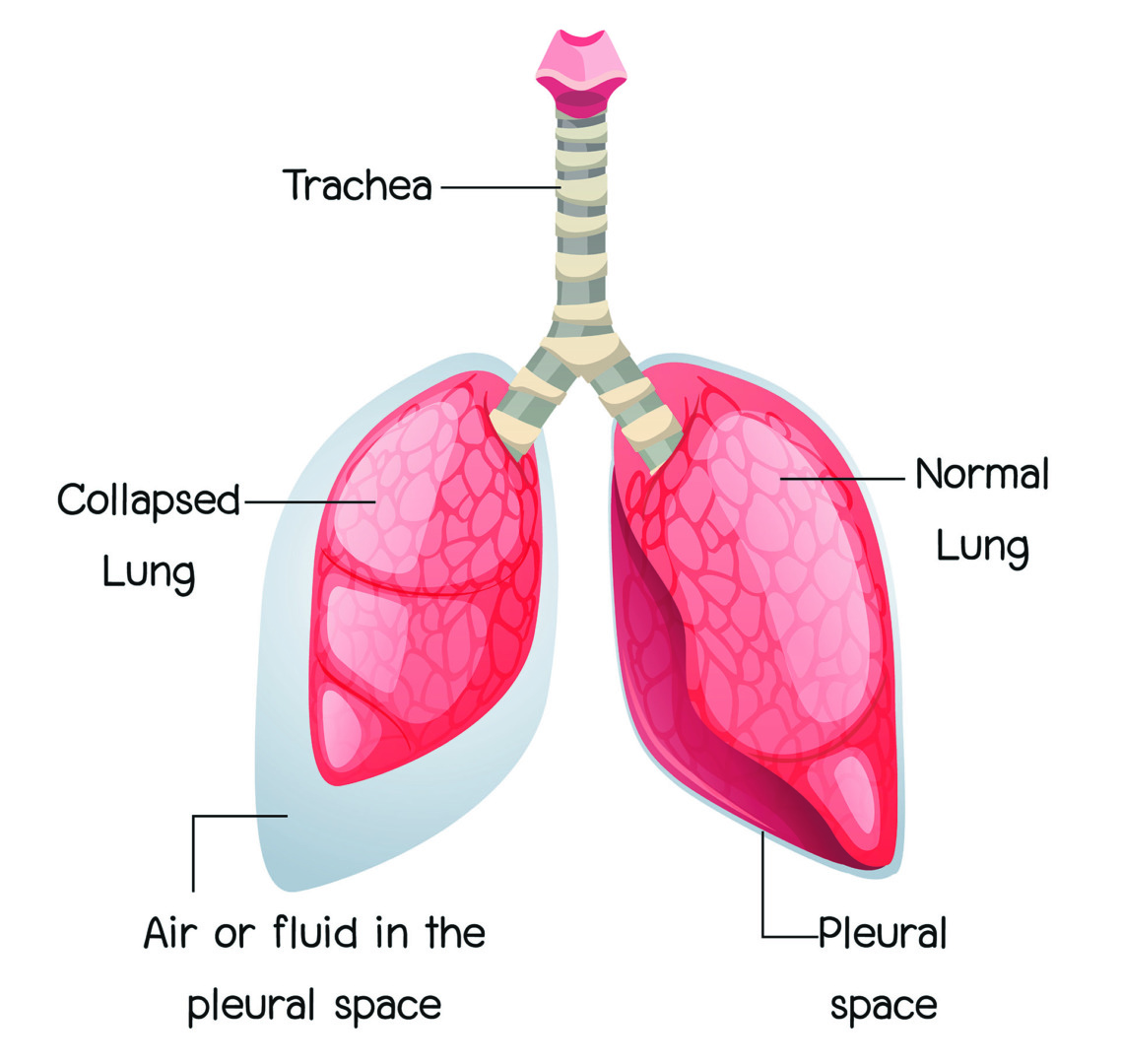 pneumothorax