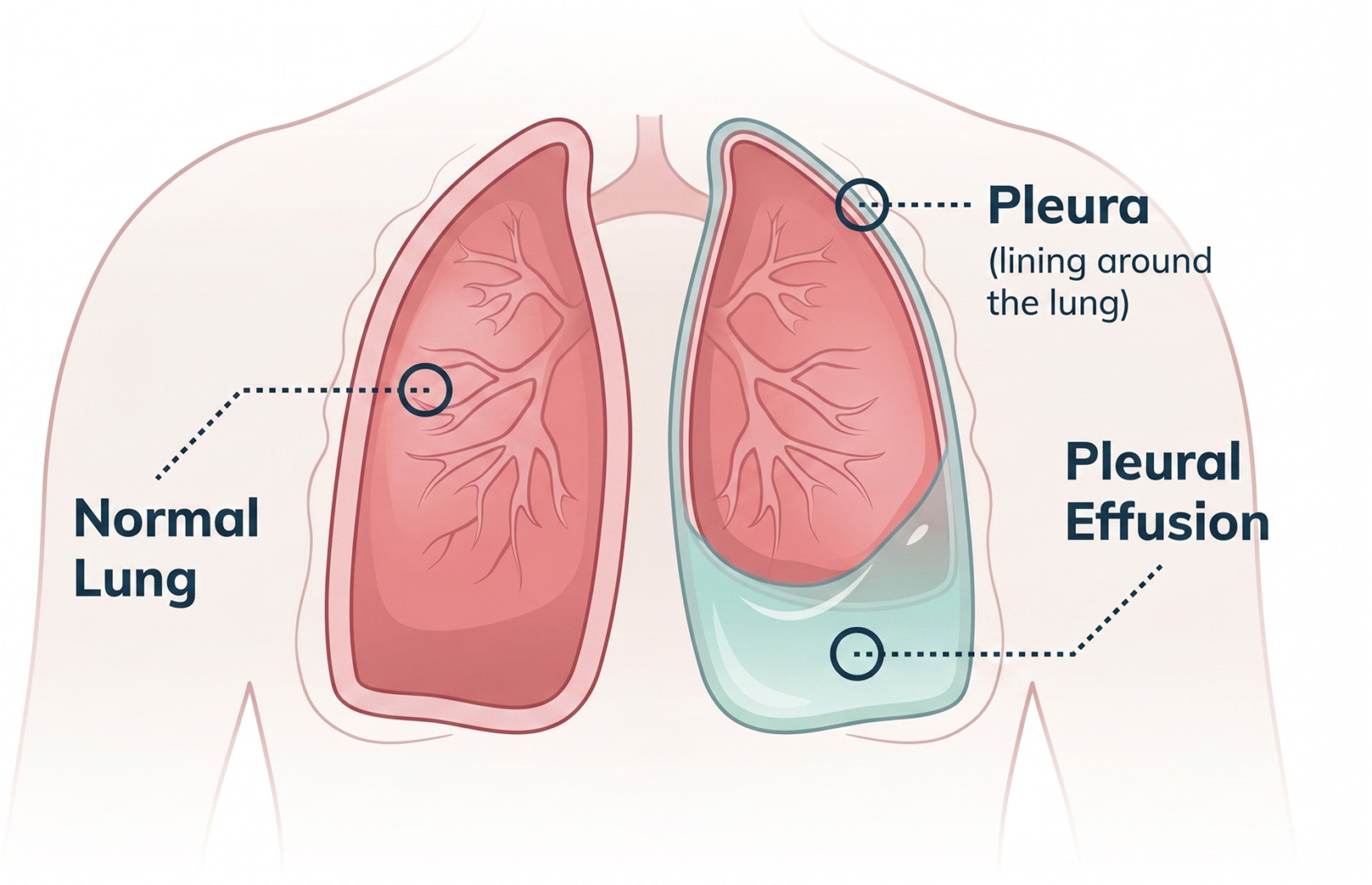 exudative pleural effusion Singapore