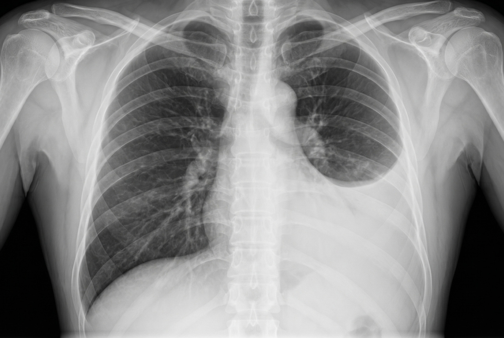 exudative pleural effusion diagnosis