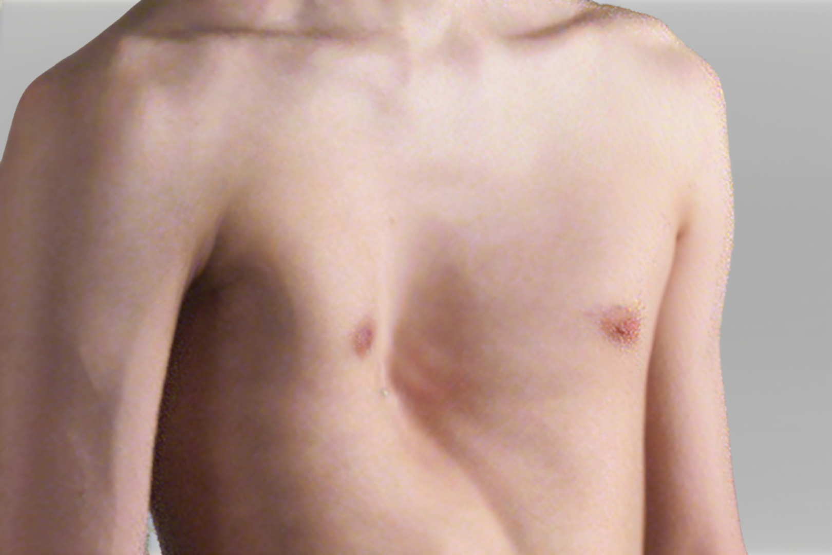 funnel chest pectus excavatum