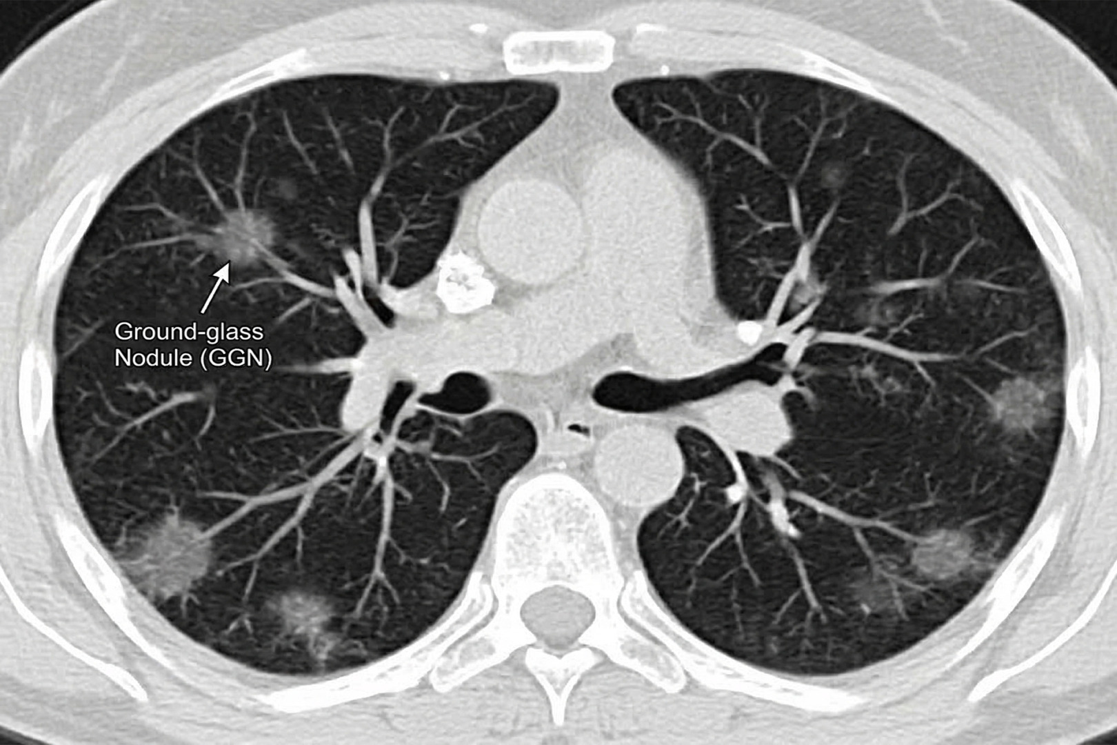 ground glass nodule X-ray