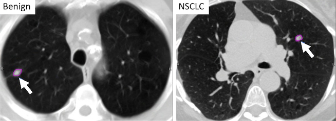 indeterminate lung nodule