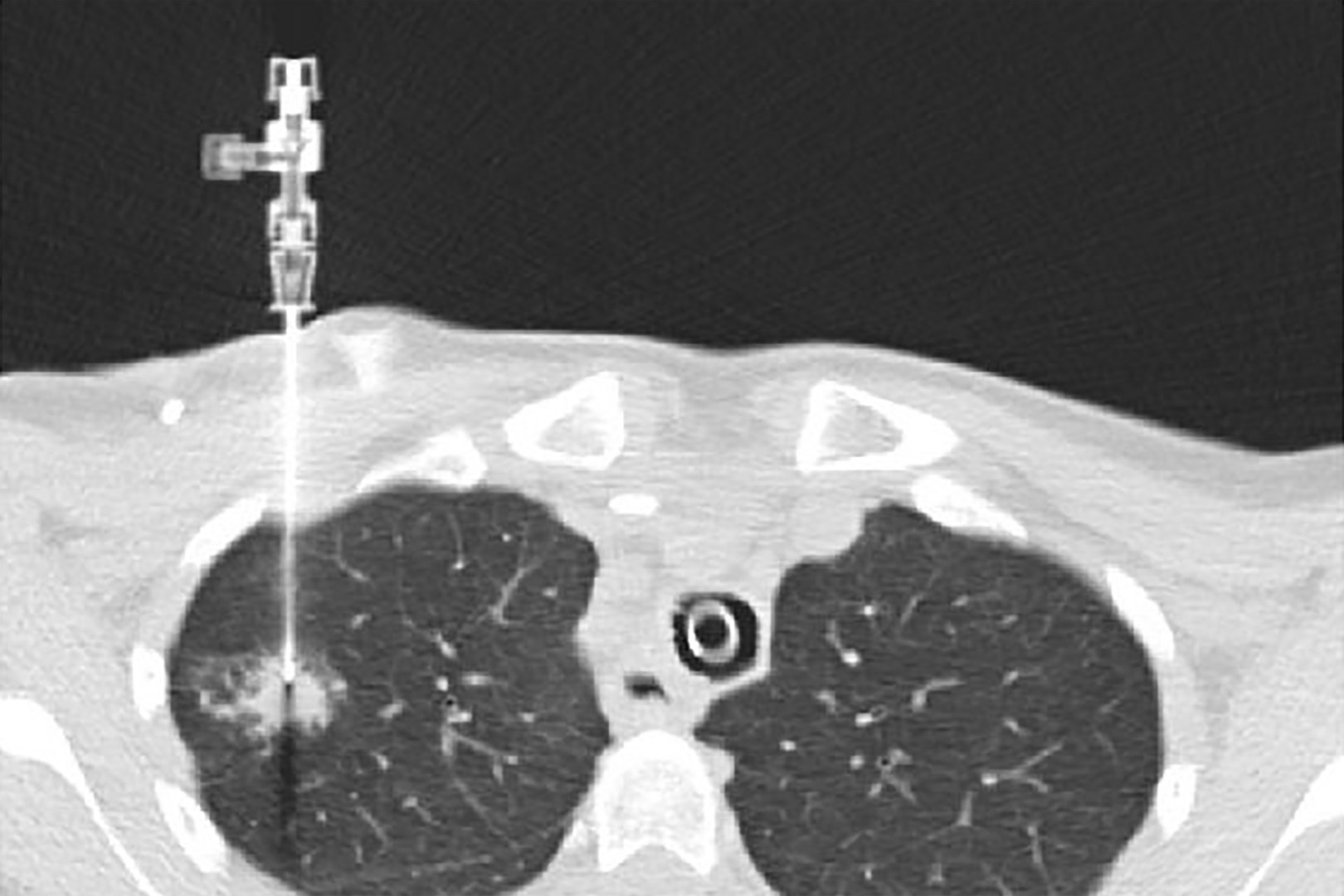lung biopsy procedure CT