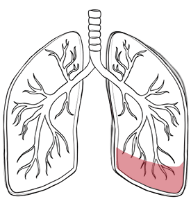lung consolidation treatment