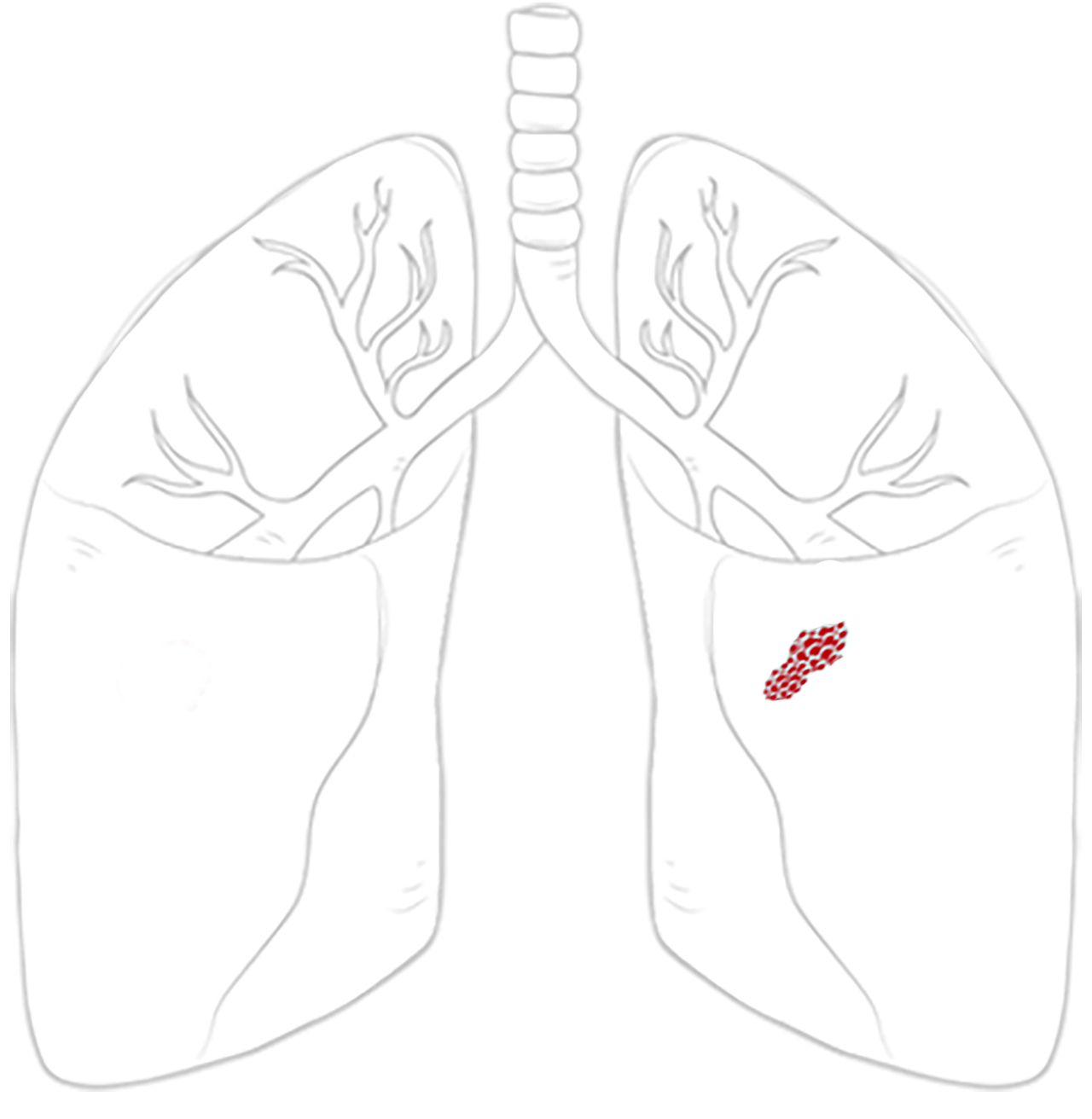 lung lesion