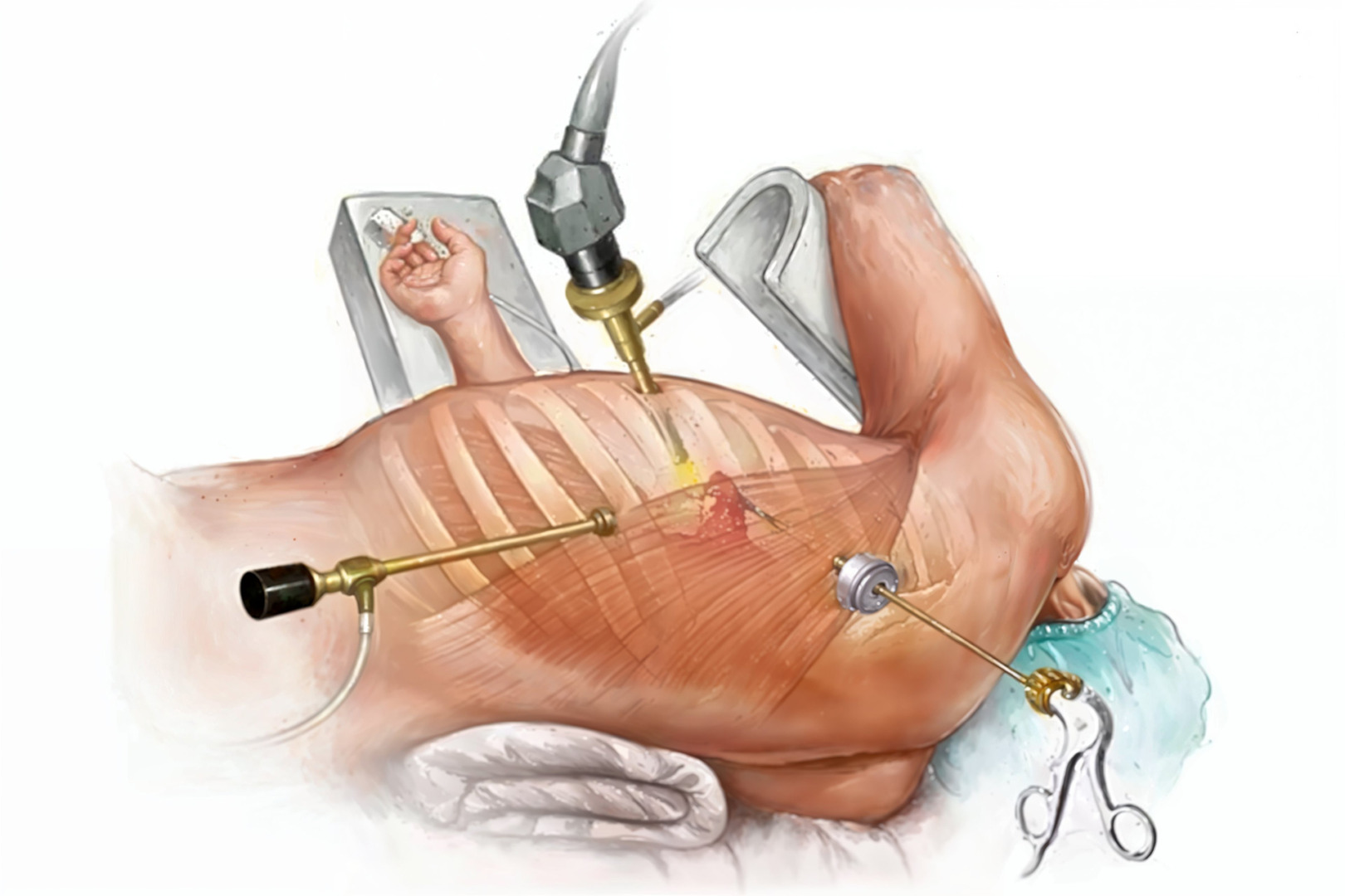 lung resection surgery