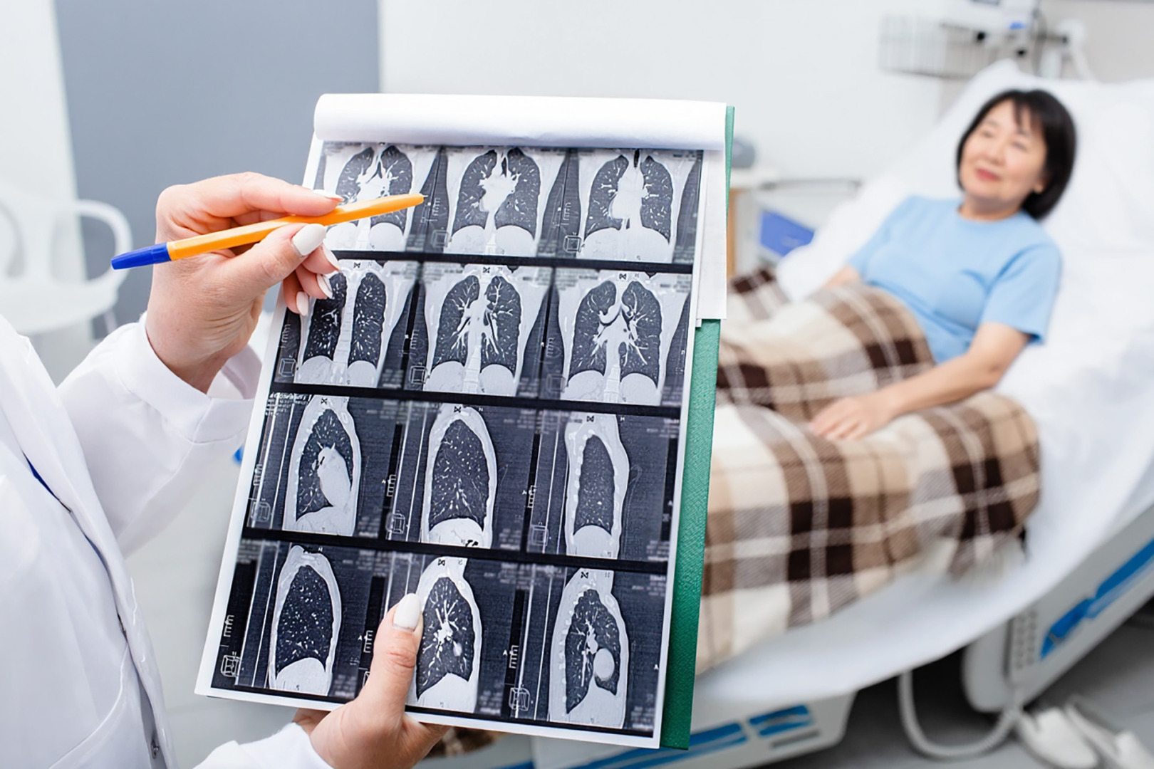 malignant lung neoplasm Singapore