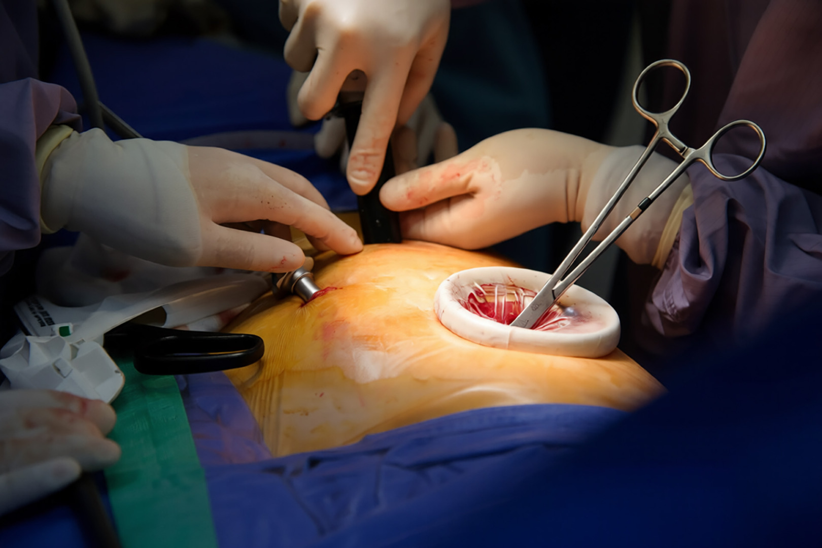 malignant lung neoplasm surgery