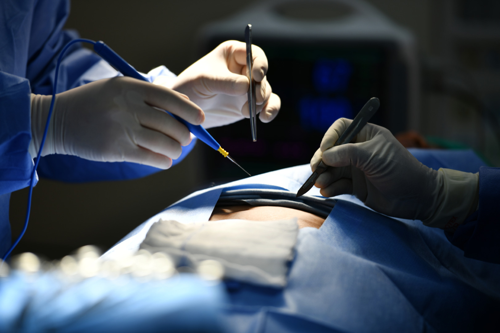 mediastinal mass surgery