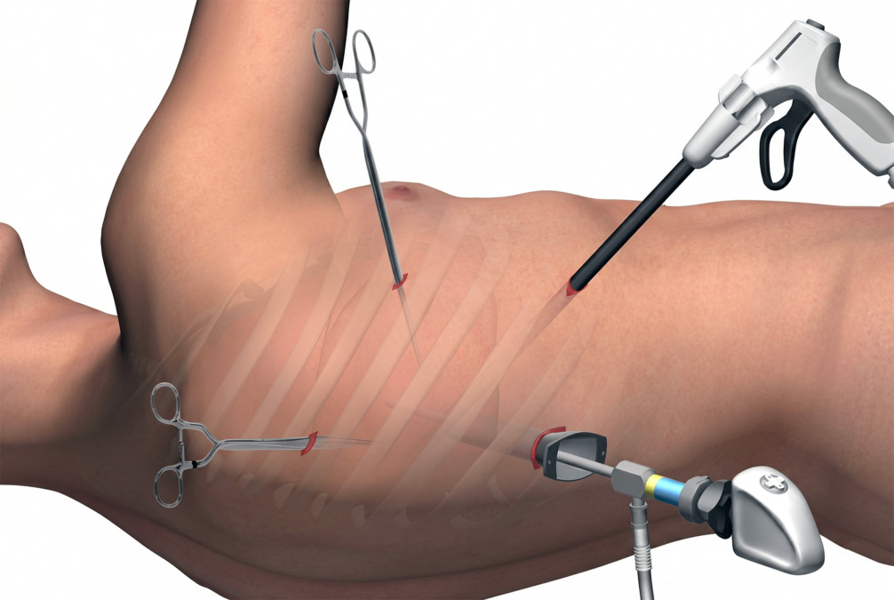 mesothelioma surgery