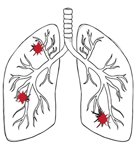 metastatic lung cancer