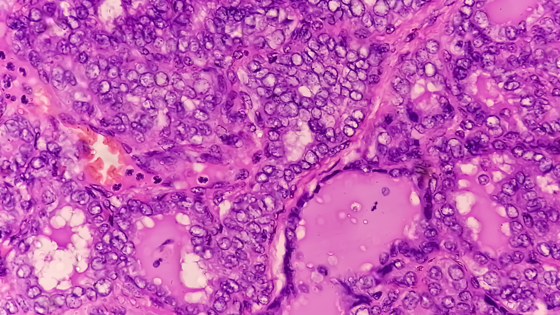 metastatic non-small cell lung cancer