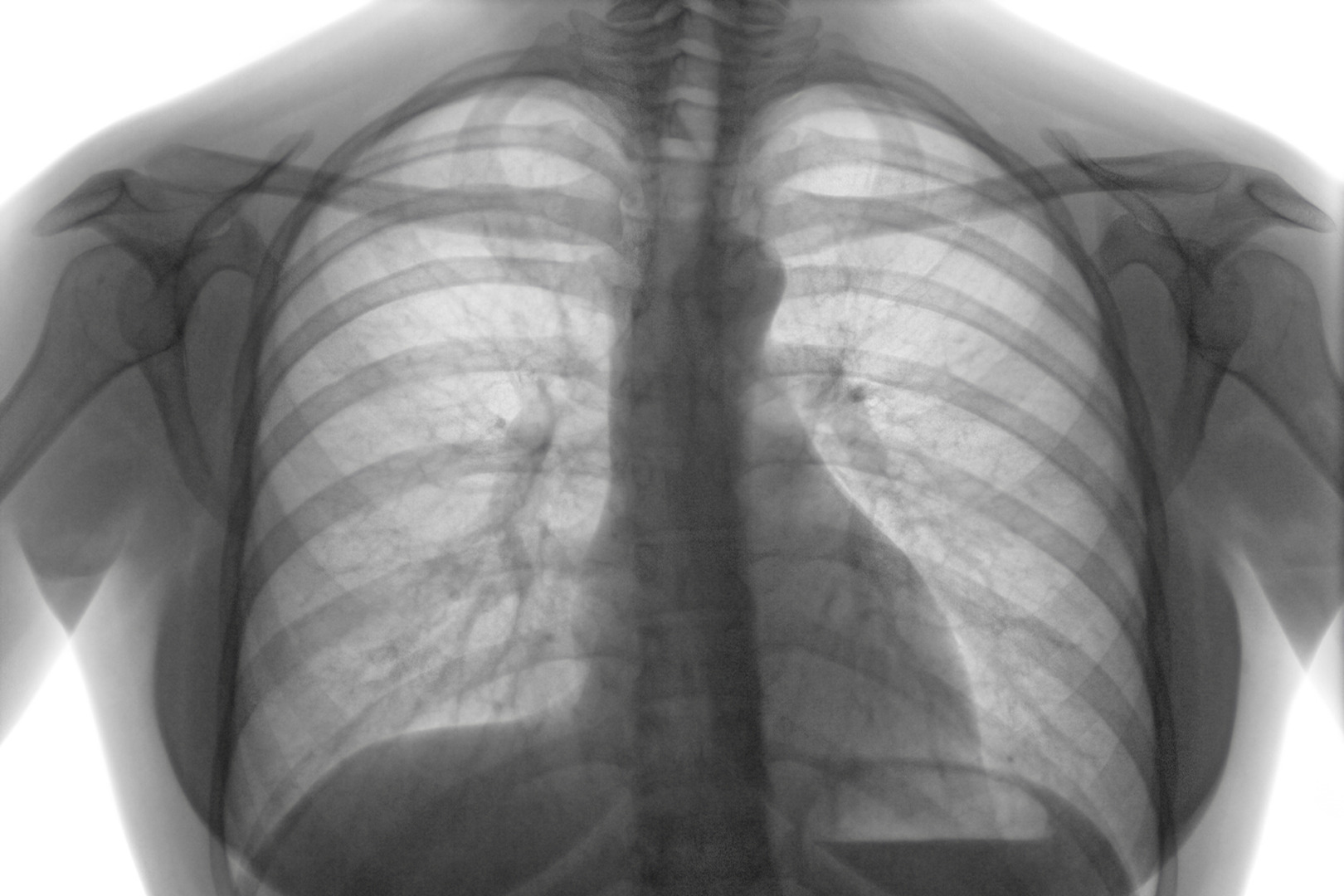 middle mediastinal mass X-ray