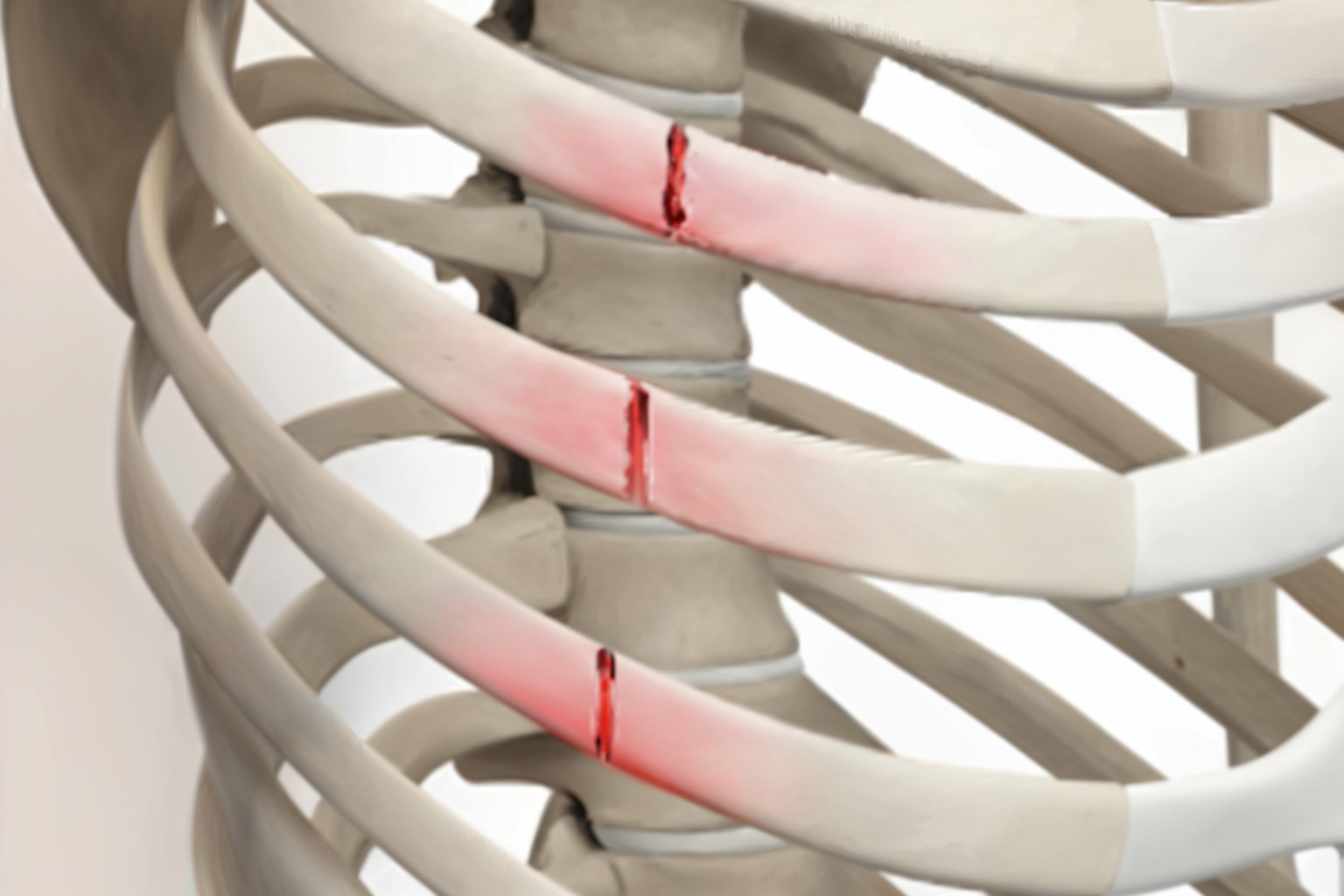 Neumark Treatment for Nonunion Rib Fractures with Internal Rib Fixation