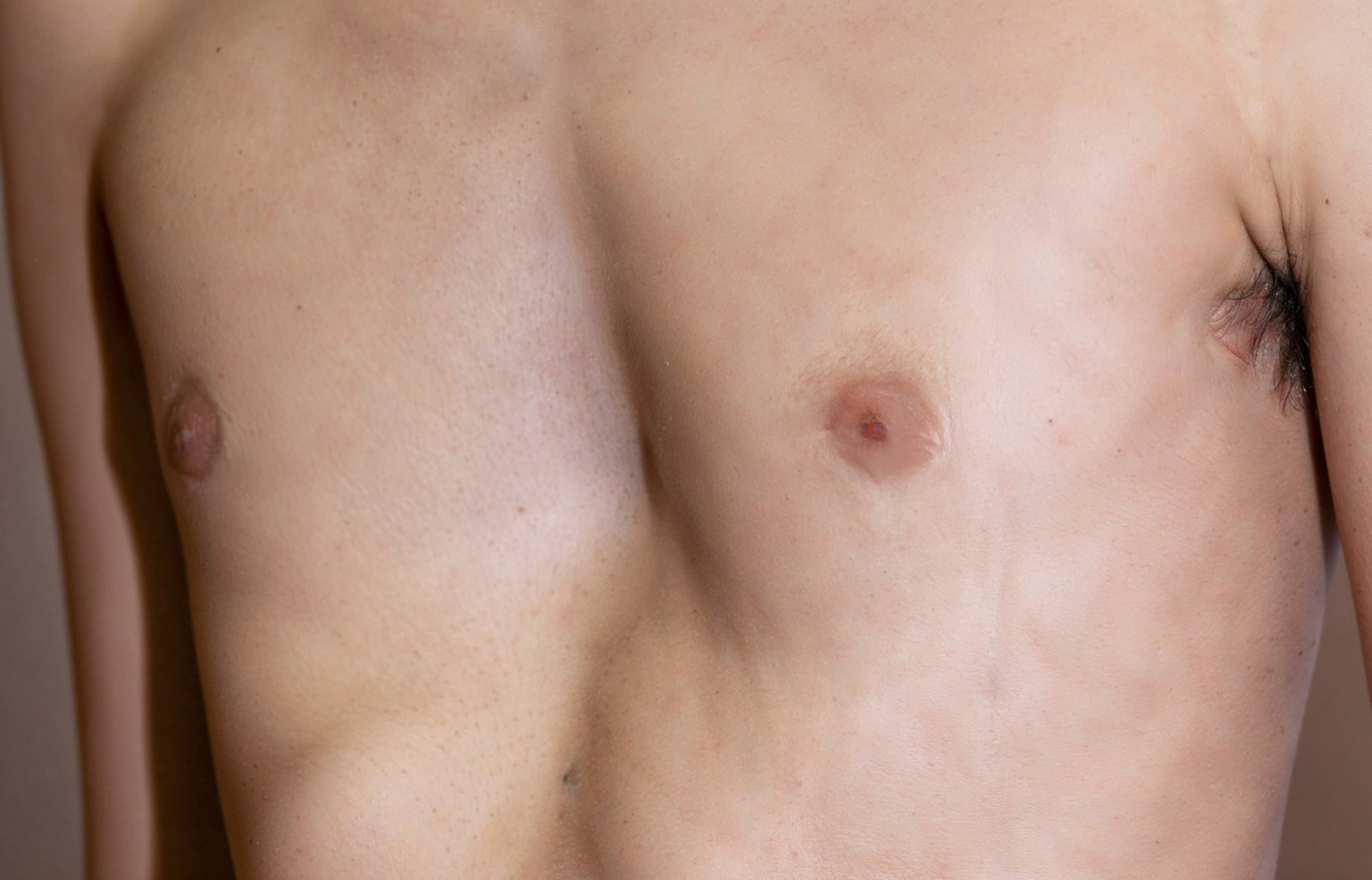 pectus excavatum pain