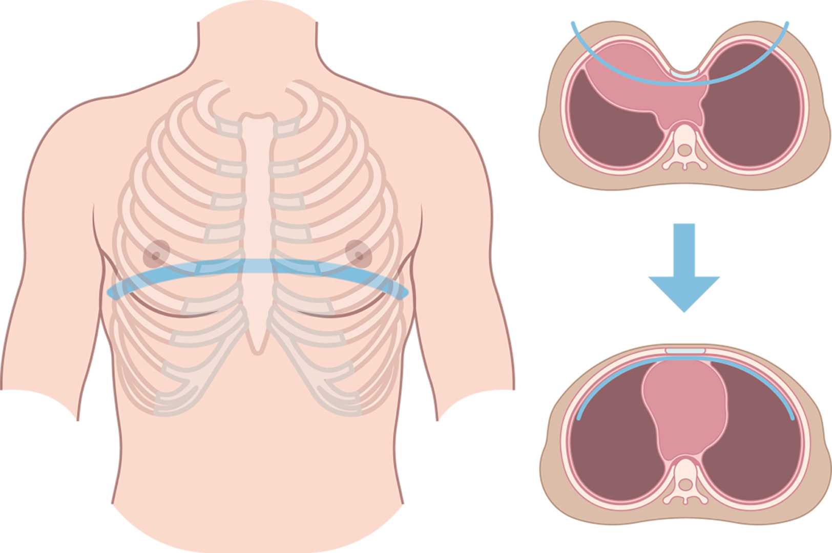 pectus excavatum surgery in adults Singapore Nuss