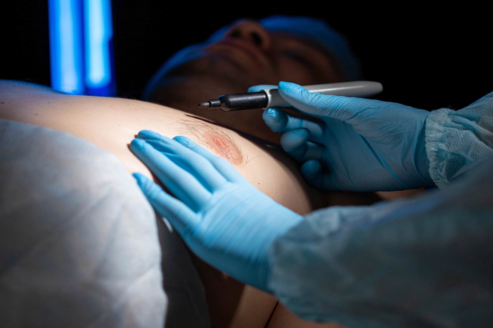 pectus excavatum surgery in adults Singapore