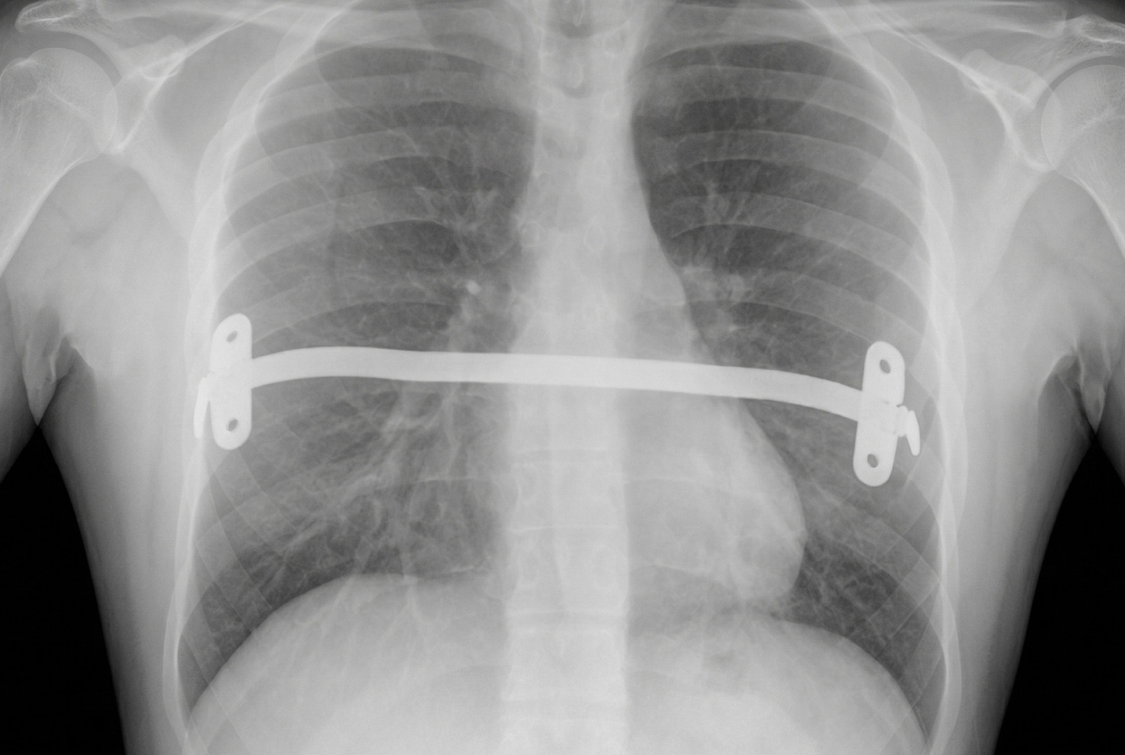pectus excavatum woman nuss
