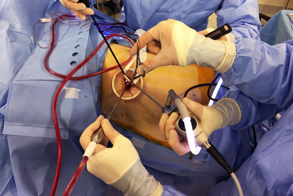 pleural decortication