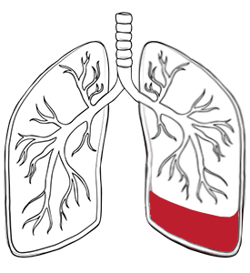 pleural effusion