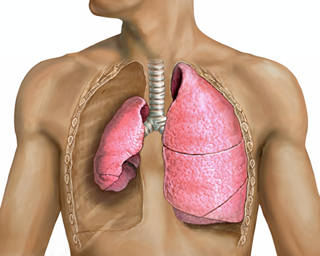 pneumothorax