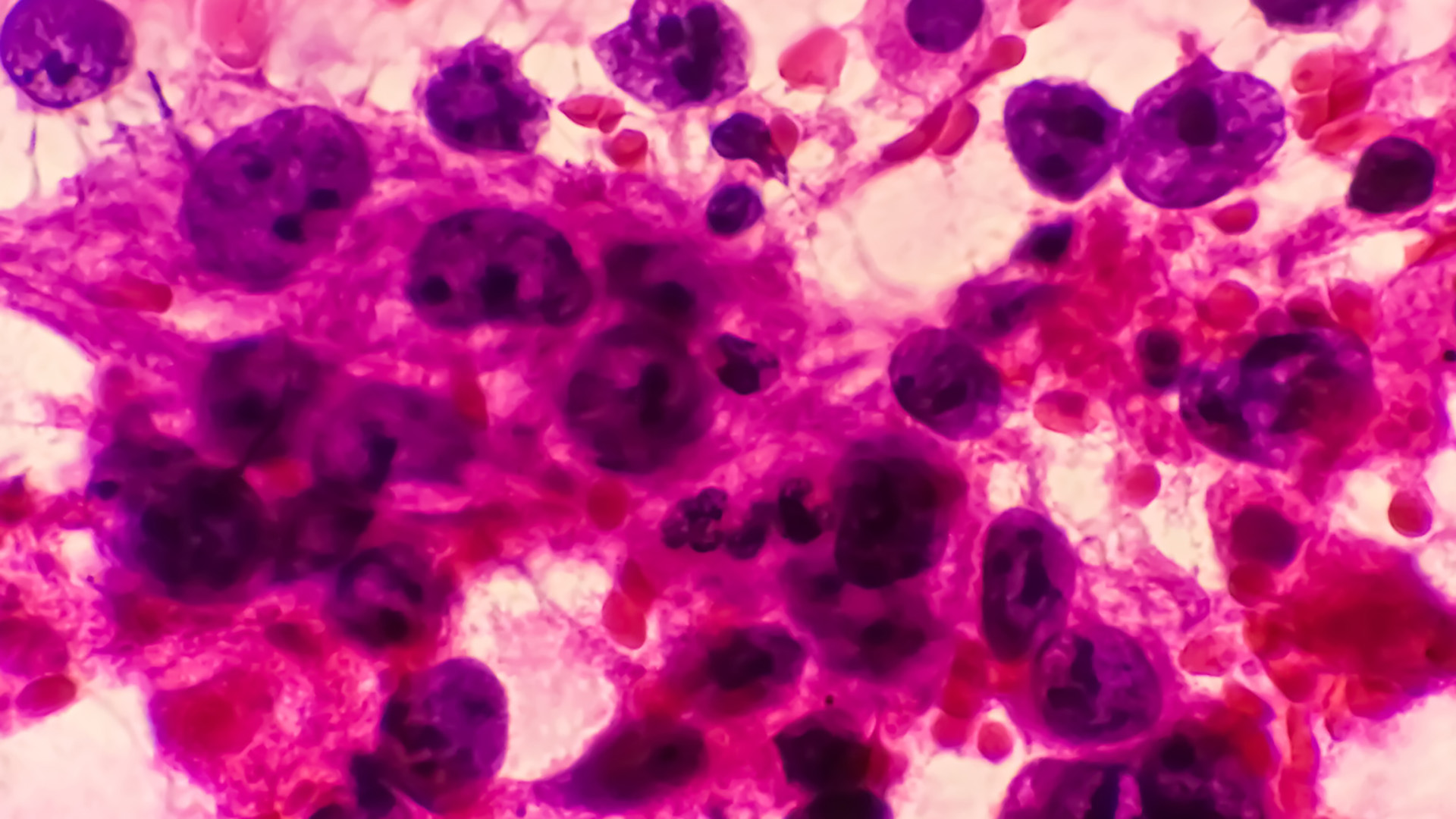 posterior mediastinal mass tumours