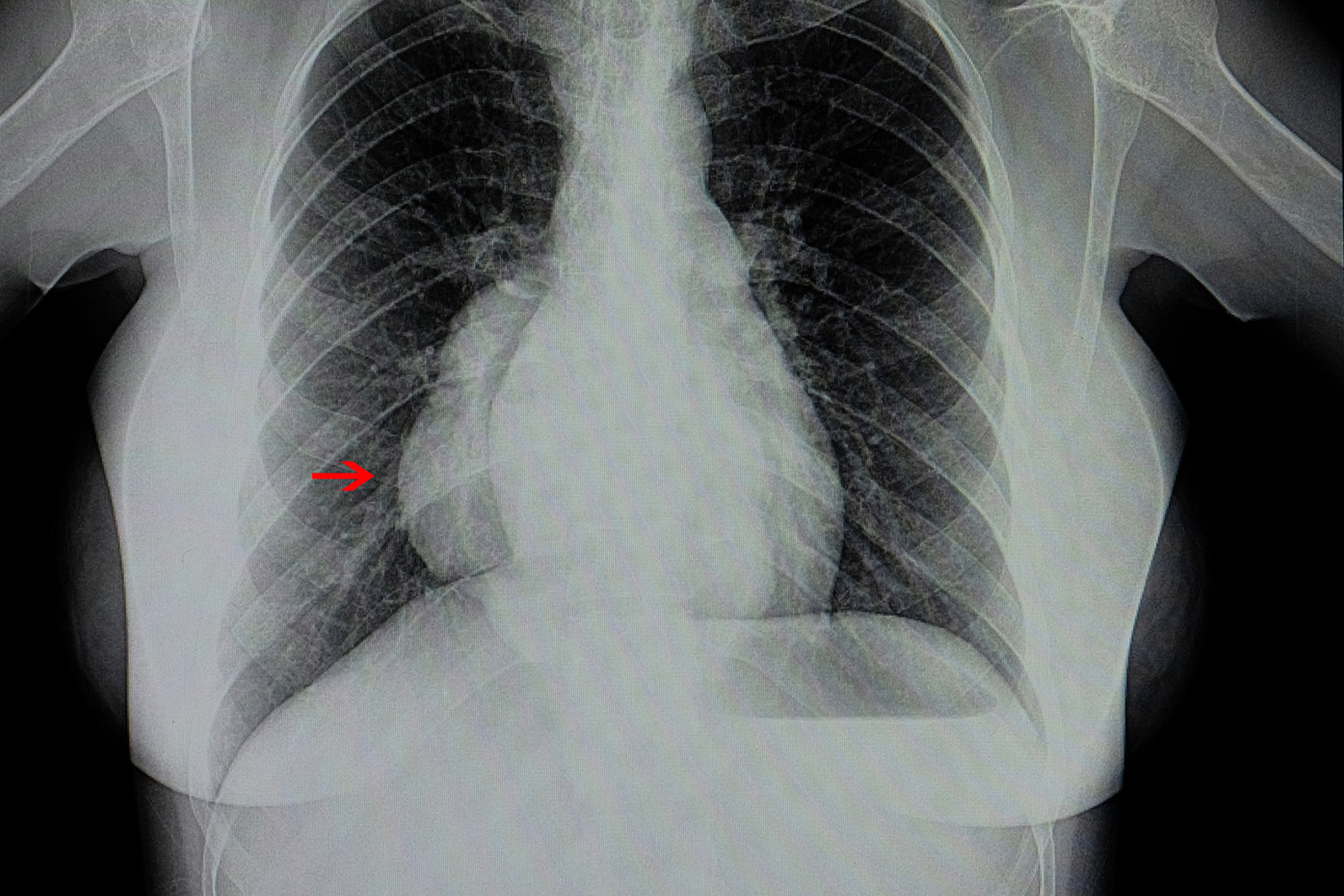 robotic assisted surgery for mediastinal masses