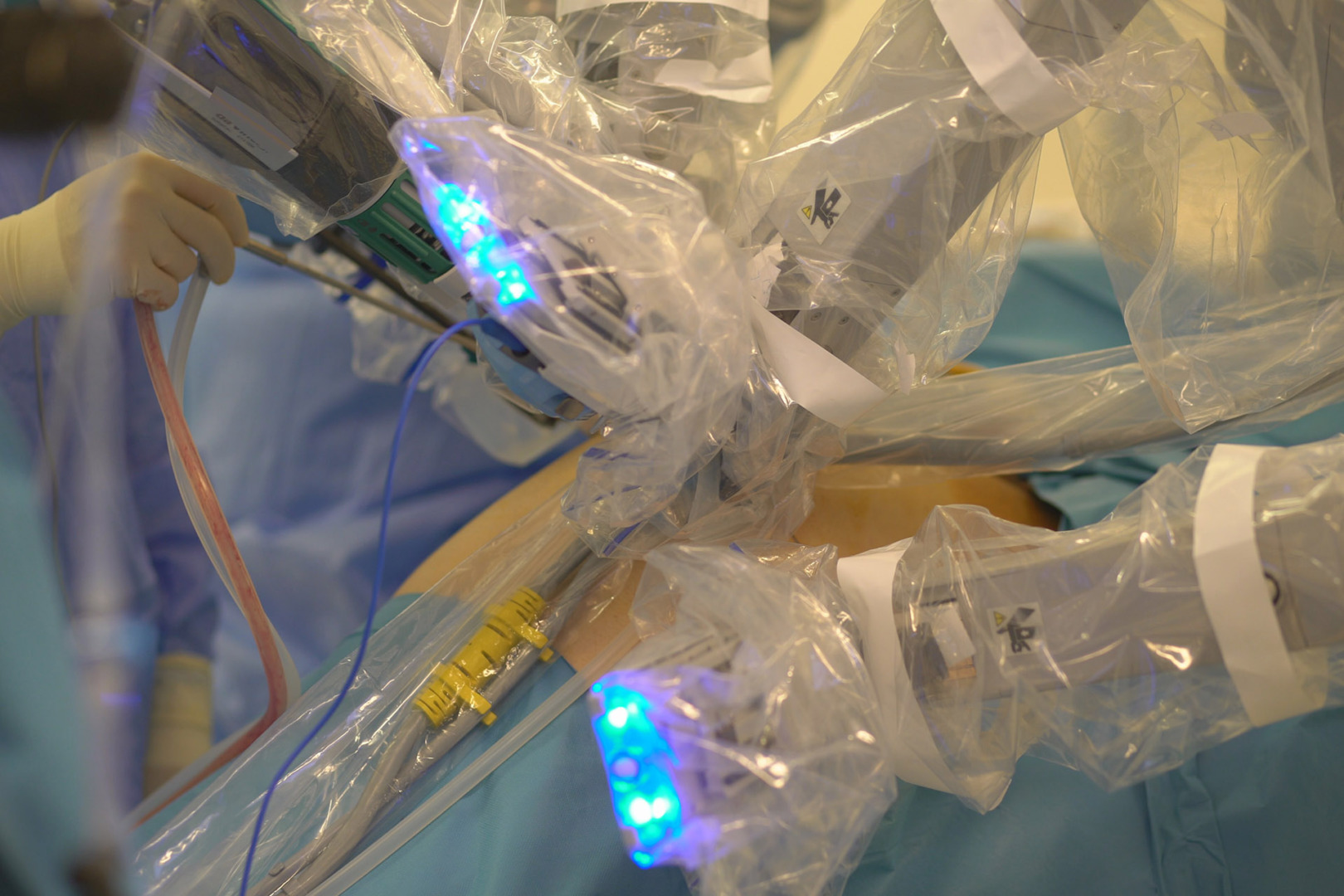 robotic assisted thoracic surgery for lung cancer tumor removal