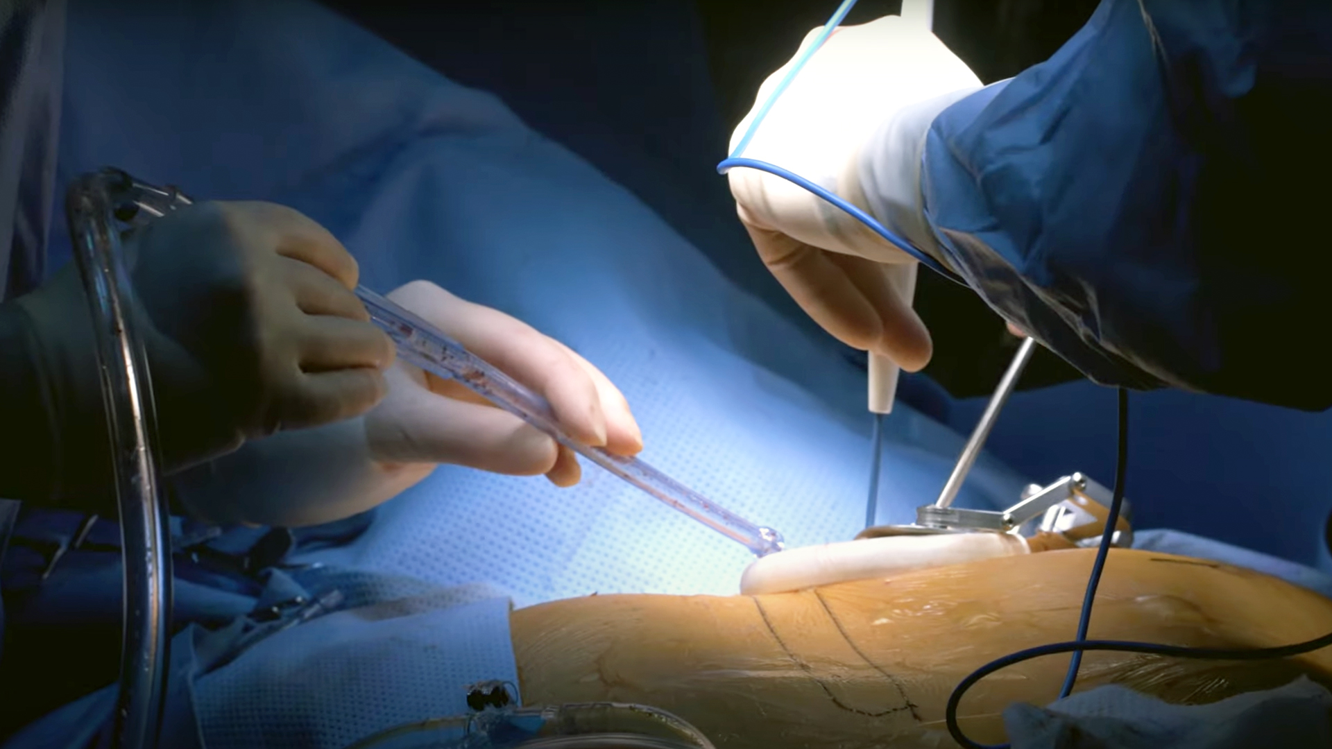 sleeve lobectomy lung surgery