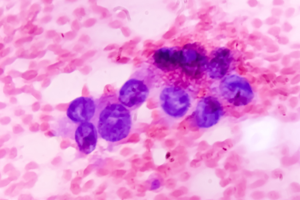 small cell lung cancer types