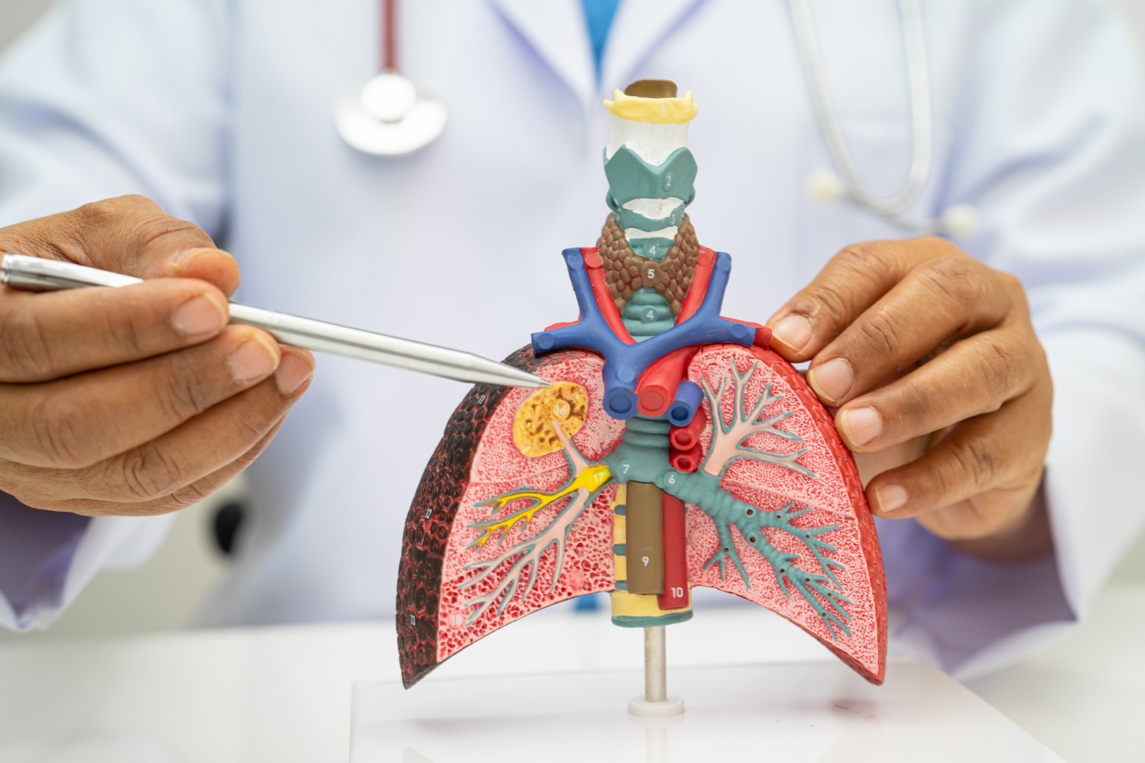 stage 1 lung cancer Singapore
