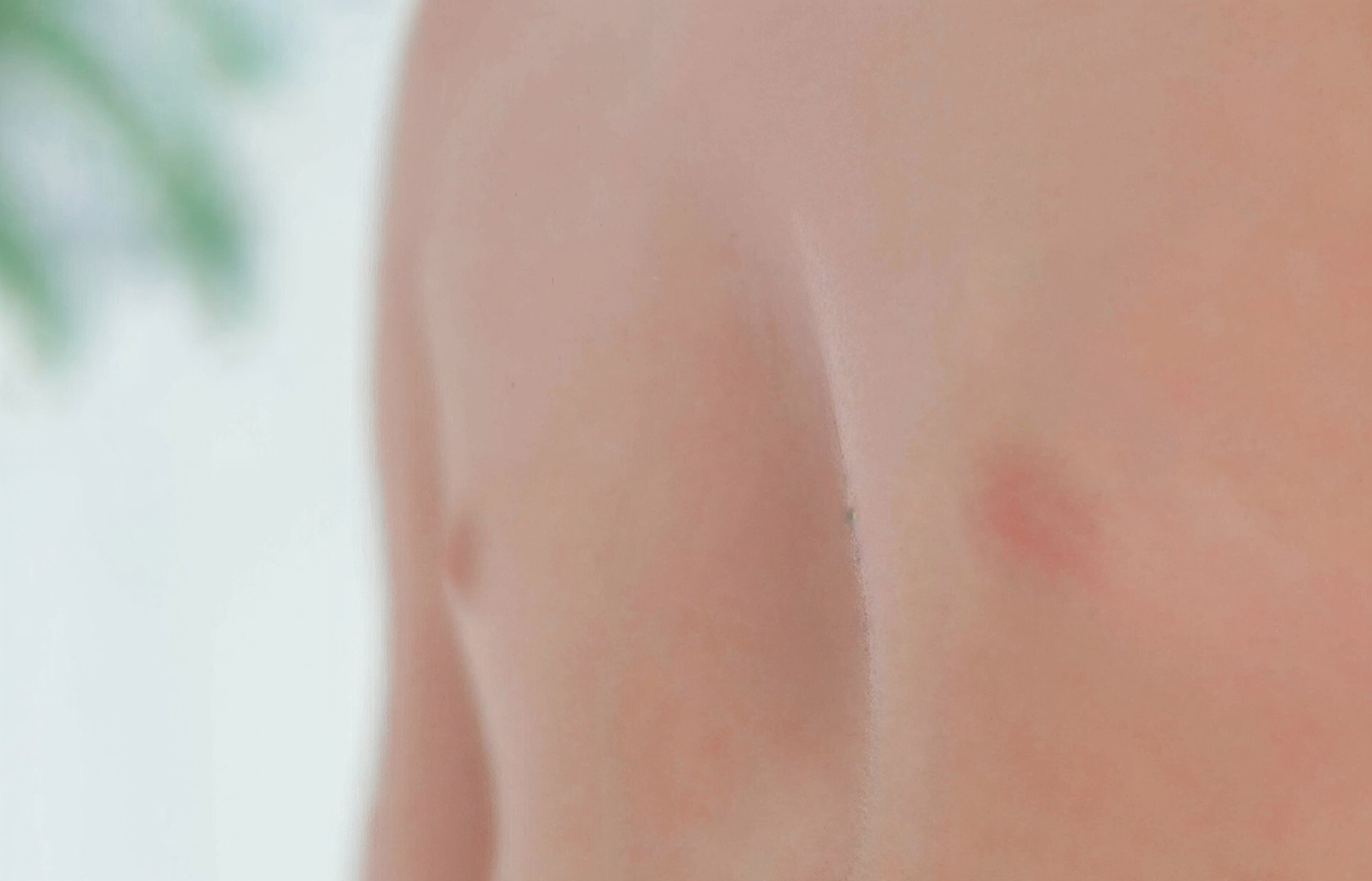 sunken upper chest causes