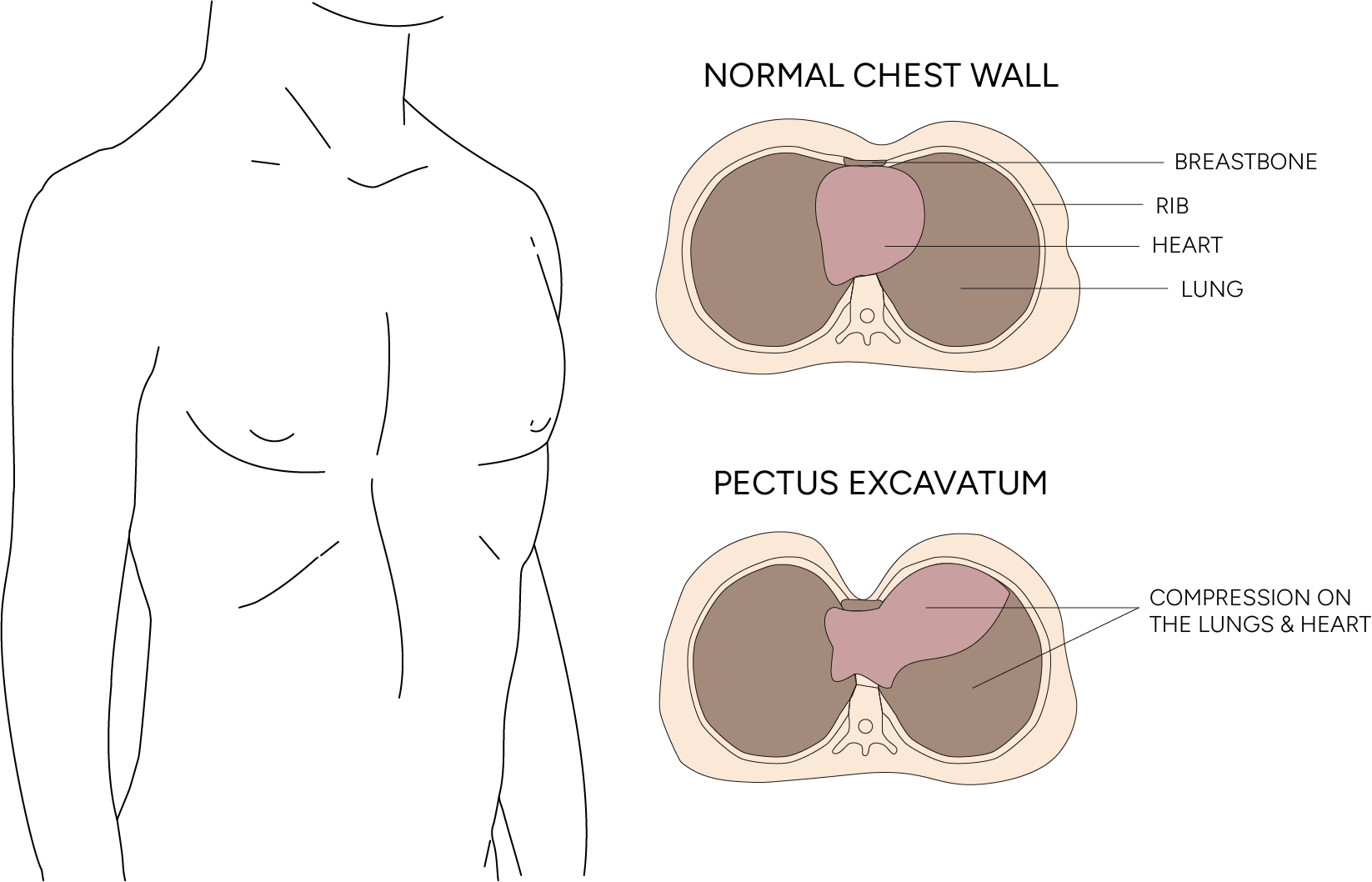 sunken upper chest surgery