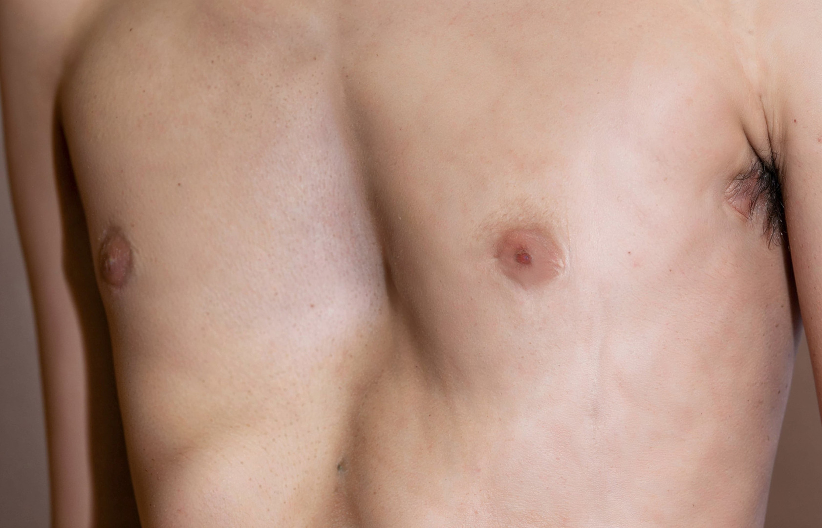 sunken upper chest symptoms